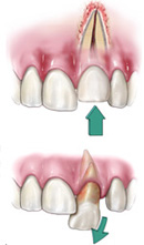 Traumatic Tooth Injury in Houston